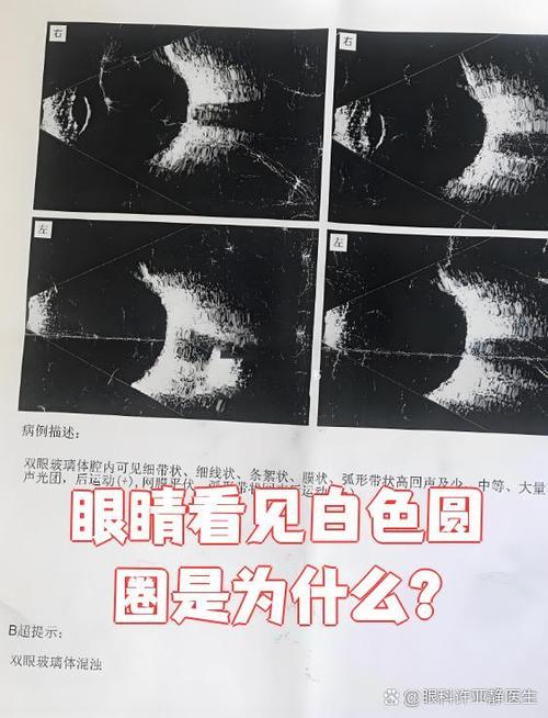 眼睛能看到白色圈圈