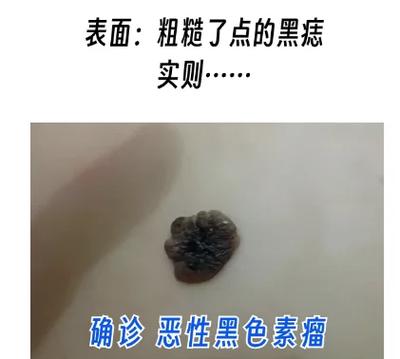 淡化抓痕黑色素要多久