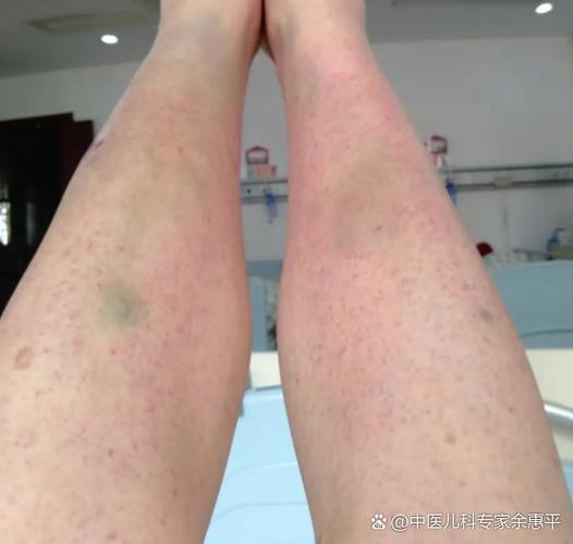 什么是血小板减少