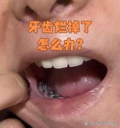 板牙烂了一半是补还是拔掉
