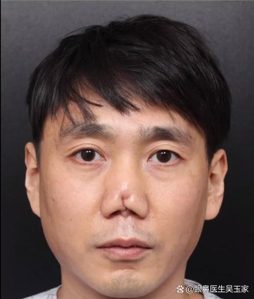 脸部组织复位术有后遗症吗