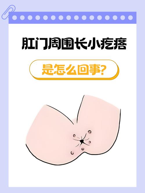 肛门周围长了小肉粒是什么原因缩略图