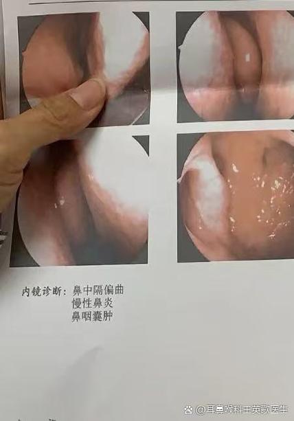 流鼻血是怎么回事引起的
