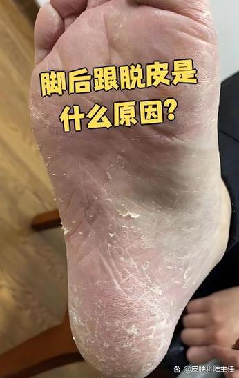 脚脱皮不痒只脱皮缩略图