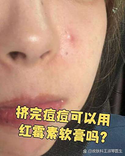 红霉素软膏可以擦脸吗