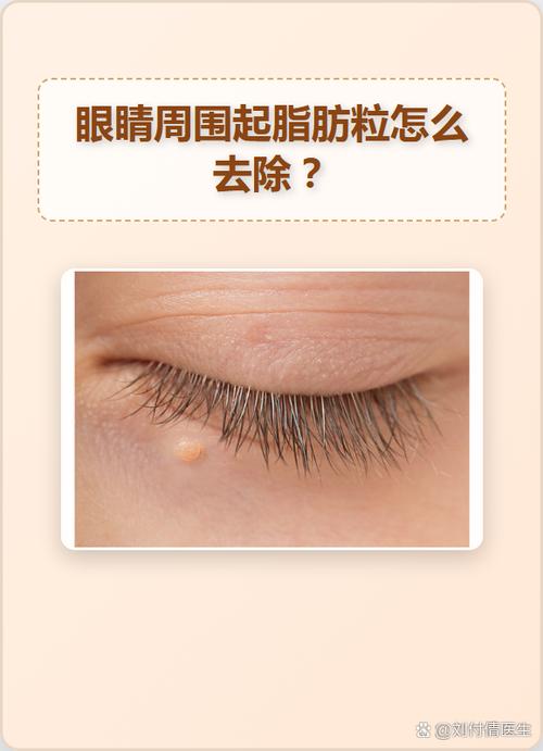 眼周脂肪粒怎么去掉