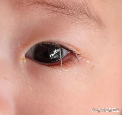 小孩眼睛流眼泪缩略图