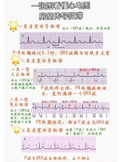 传导阻滞能活多久