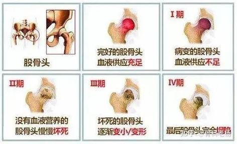 什么人容易得股骨头坏死