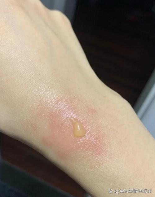 烫伤去疤痕最佳时间