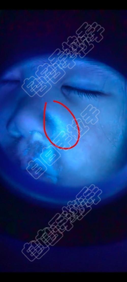 伍德灯下正常皮肤图片