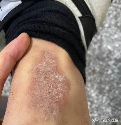 真菌病毒感染怎么治疗截图