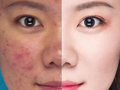 怎么把照片上p上痘痘