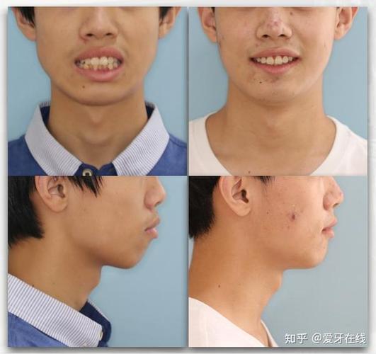 整牙齿矫正