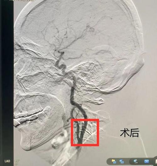 照影是手术吗