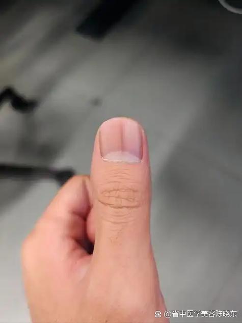 女性指甲有黑线要警惕
