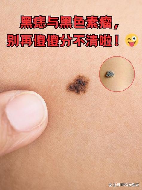 看黑痣挂什么科