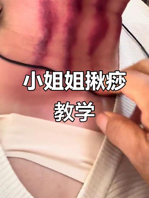揪痧脖子女人痛哭