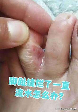 脚趾缝里烂了怎么办