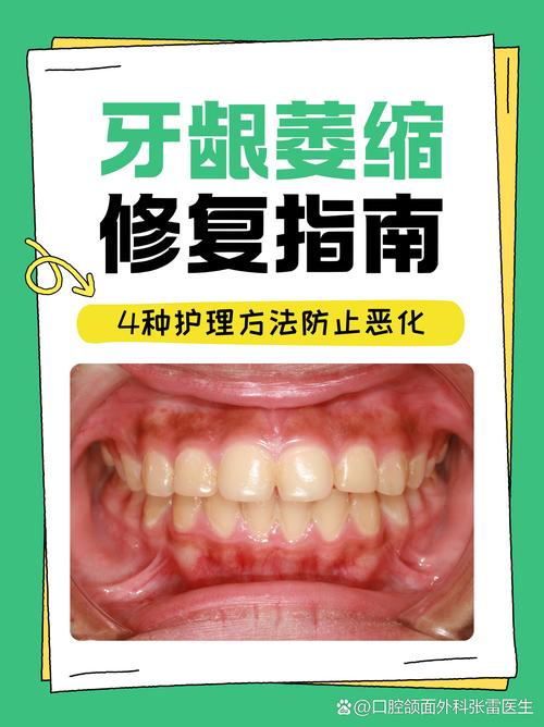 牙龈肿痛能自愈吗