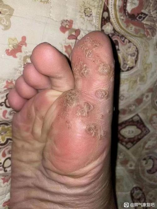脚病毒感染传染吗游戏截图