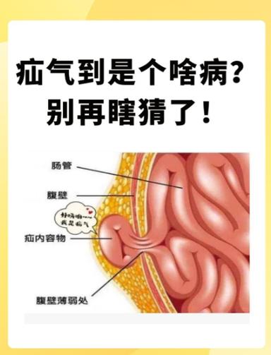 疝气会自己缩回去吗