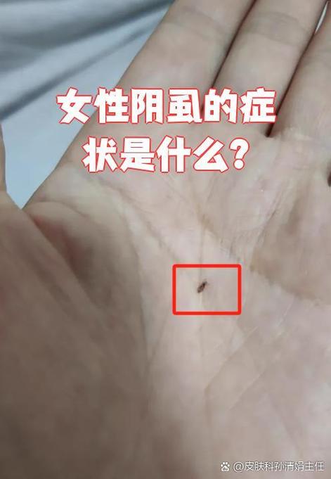 阴虱子症状图片
