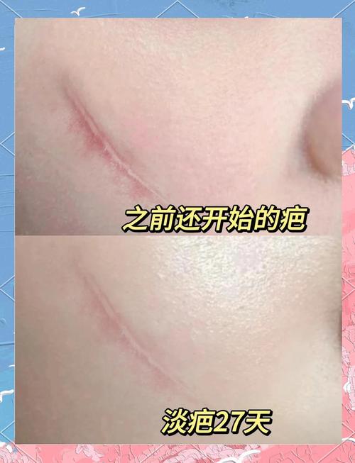 抖音疤痕特效在哪里