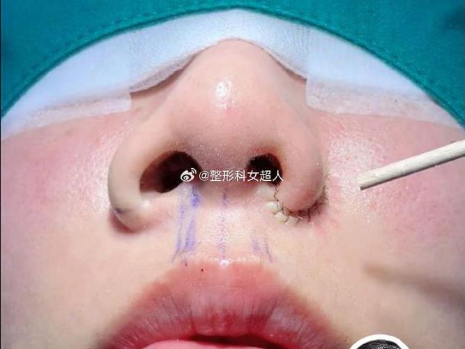 日本缩鼻翼原视频