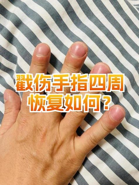 手戳伤肿了一般几天能消