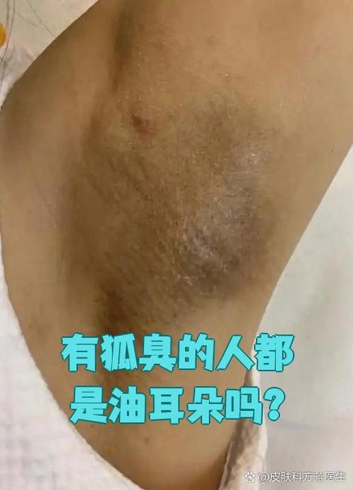 油耳朵一定有狐臭吗