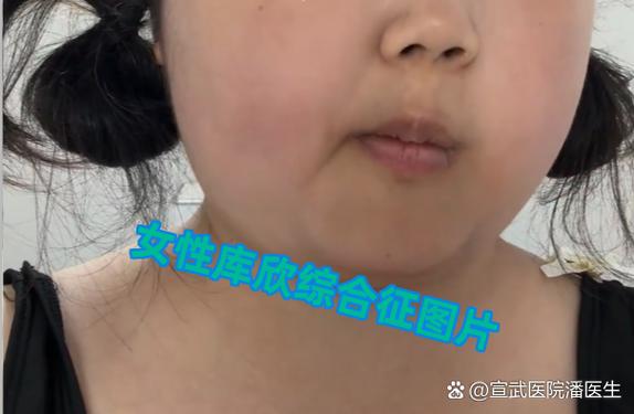 库欣病手术后容貌会改变吗