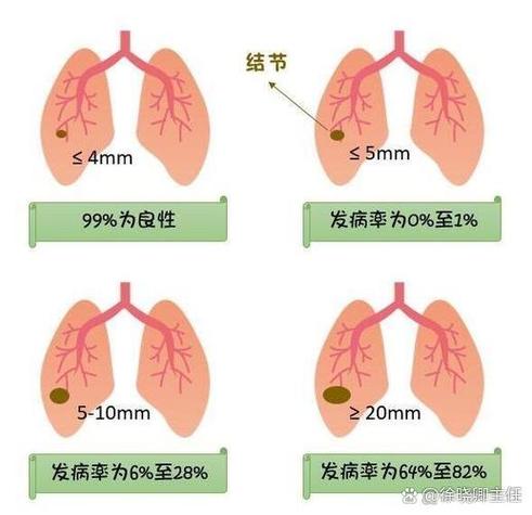 肺结节产生的原因截图