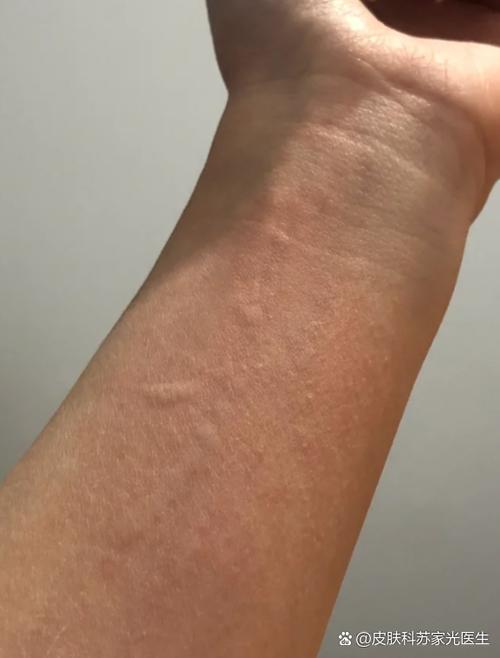 皮肤痒一抓就起小颗粒