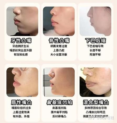 怎么防止嘴巴越来越凸