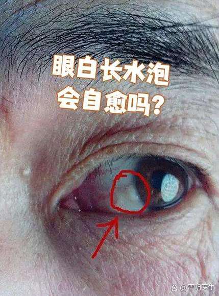 正常人的眼白图片图标