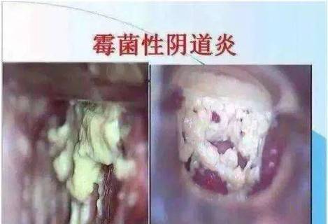 霉菌和念珠菌一样的吗