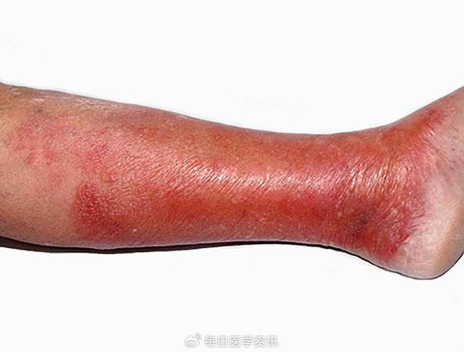 丹毒皮肤病图片