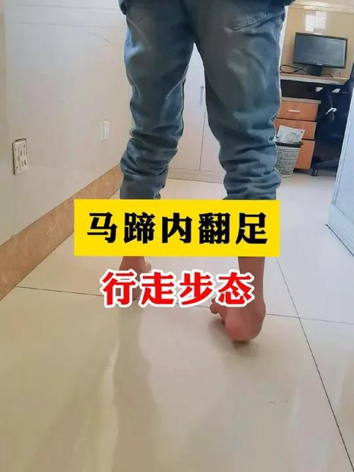 马蹄足走路视频