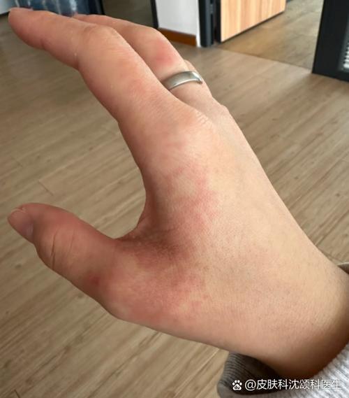 用了肥皂洗衣服 手出现红点点