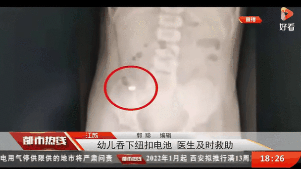 误吞纽扣电池十几年