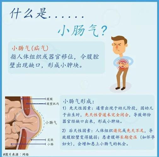 70岁老人该不该做疝气手术