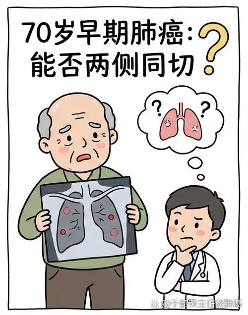 70岁肺癌有必要治疗吗