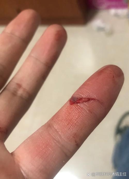 手指划伤后感觉跳动