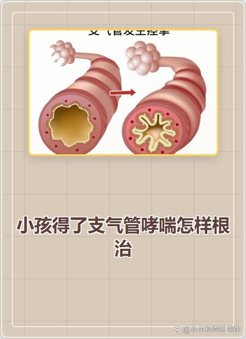 哮喘病可以根治好吗