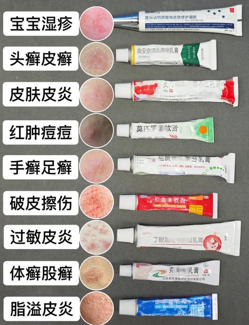 湿疹怎么才能彻底治好