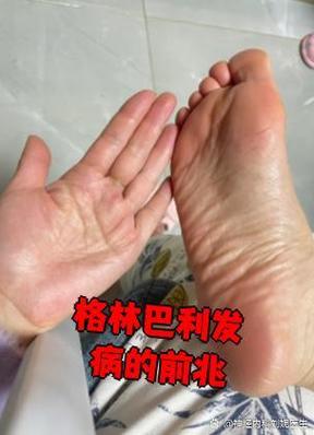 格林巴利早期症状表现游戏截图