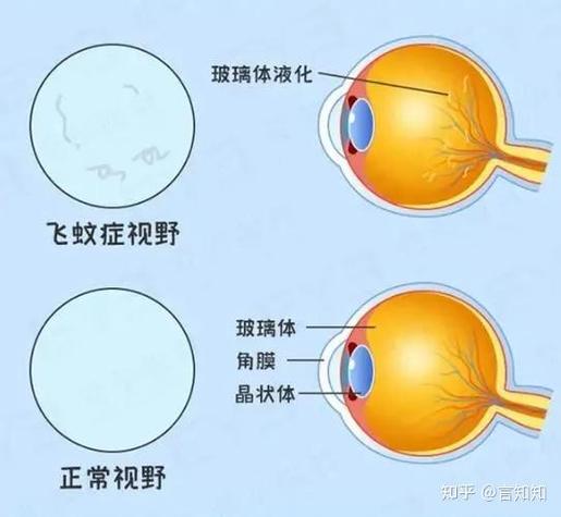 眼睛有黑影怎么恢复