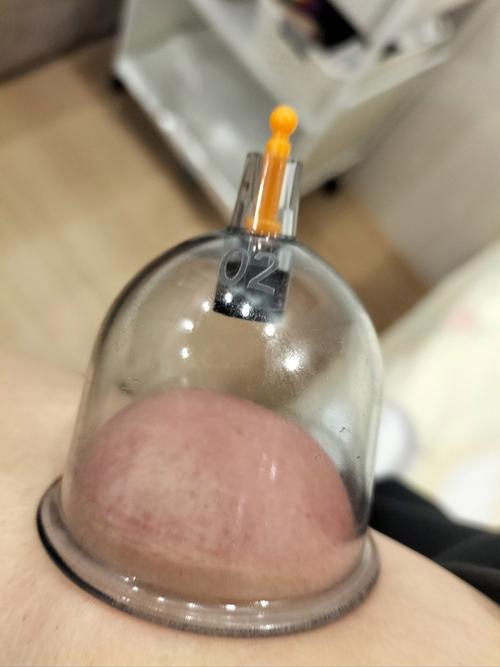 每天给丁丁拔罐半小时有效果吗图标