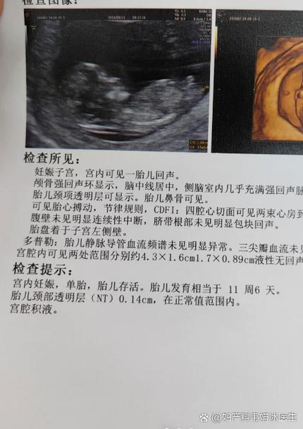 做nt检查的费用